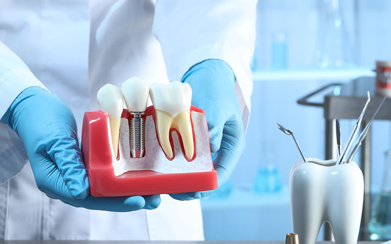 Morrison Dental - Dentist holding a diagram of an implant