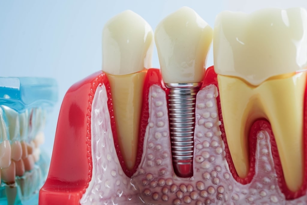 dental implants in fort mcmurray