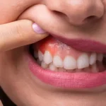 gum swelling in fort mcmurray