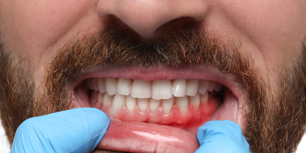 What Bleeding Gums Really Mean for Your Oral Health