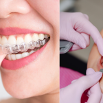 Invisalign vs Veneers_ Feature image