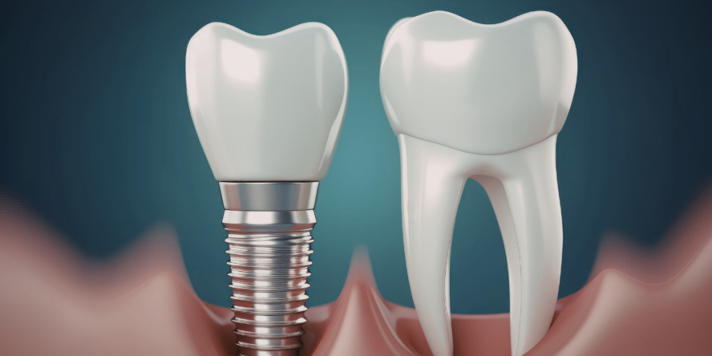Daily Life After Same-Day Dental Implants
