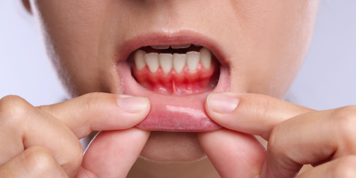 Dealing with Dental Abscess or Infection