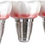 Same-Day Dental Implants_ Feature image