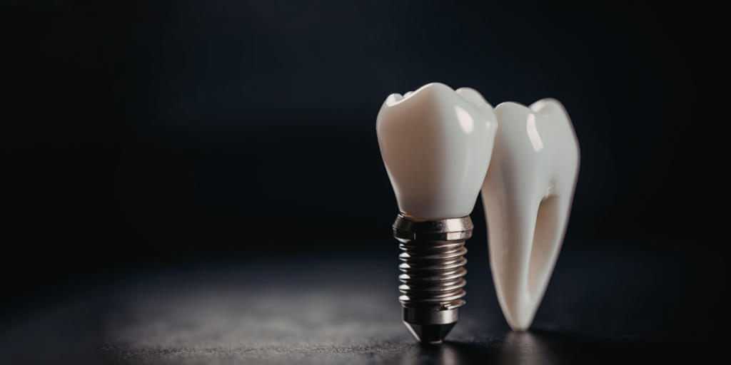 Understanding Same-Day Dental Implants