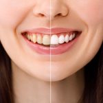 teeth whitening myths dentists want you to stop believing