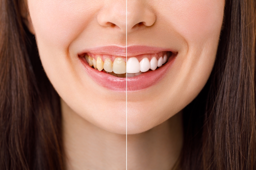 teeth whitening myths dentists want you to stop believing