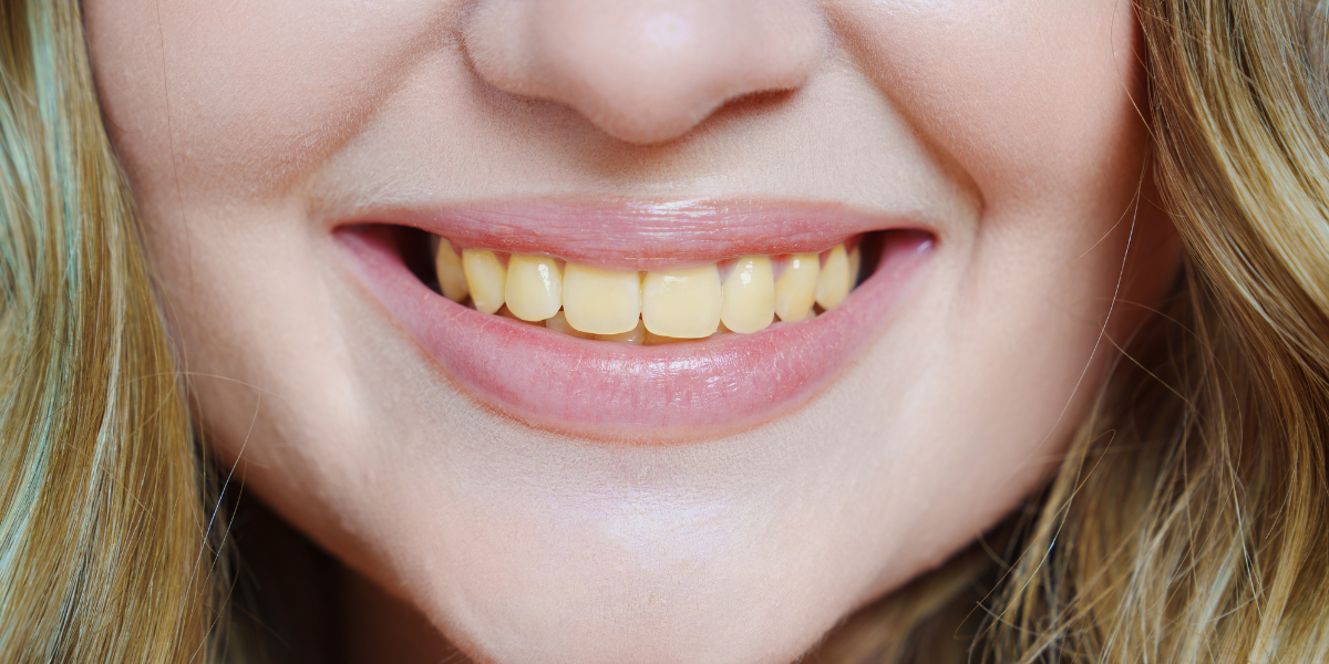 Common Causes of Yellow Teeth