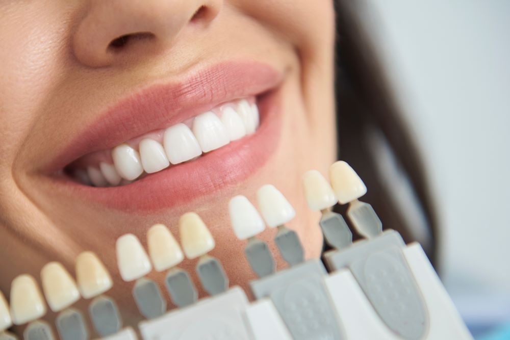 teeth whiteniing fort mcmurray