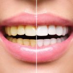 teeth whitening near you