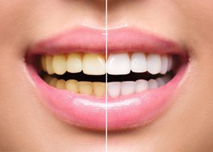 teeth whitening near you