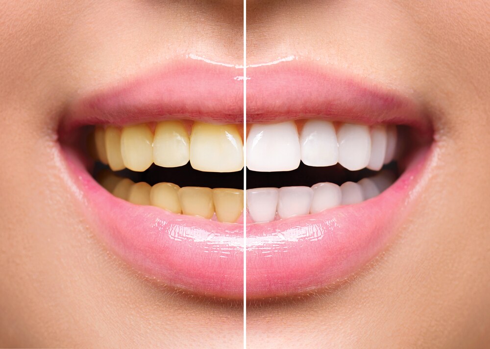 teeth whitening near you