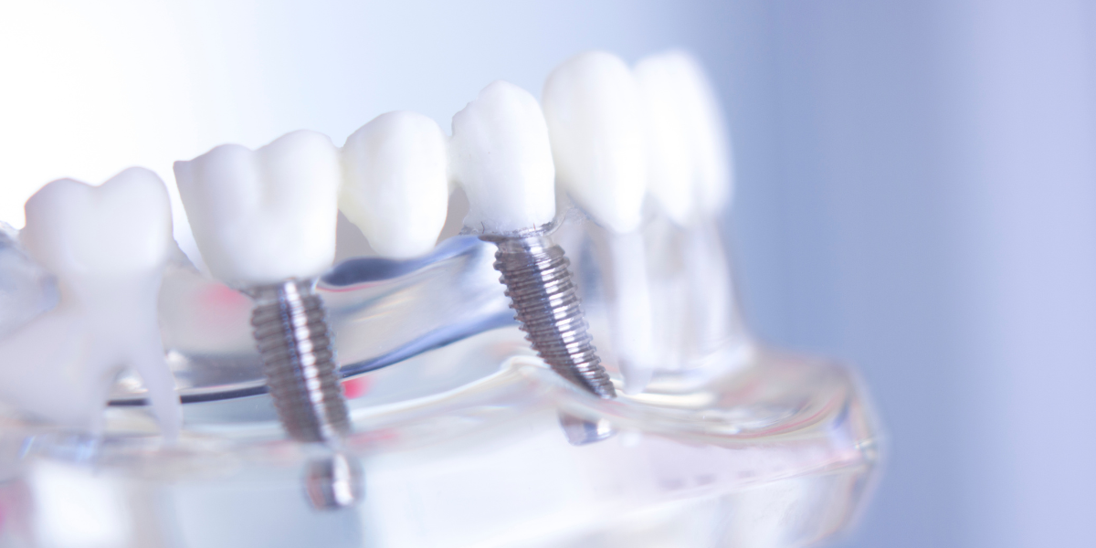 Understanding Dental ImplantsThe Foundation of Modern Tooth Replacement